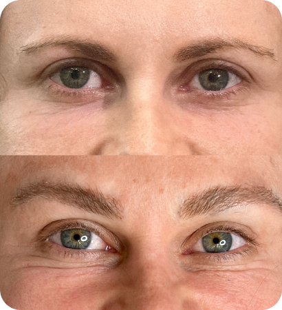 Transplante de sobrancelhas Everbrow - comparação antes e depois com recuperação completa