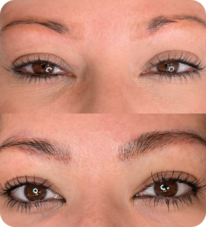 Resultado real de transplante de sobrancelhas na Lu Medical - transformação natural